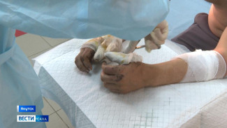 В Якутске около двухсот человек ежегодно обращаются в ожоговый центр с обморожениями