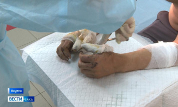 В Якутске около двухсот человек ежегодно обращаются в ожоговый центр с обморожениями