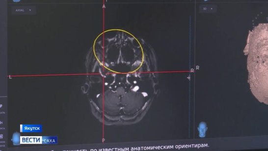 В Якутии проводится неделя сохранения здоровья головного мозга